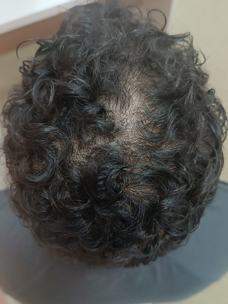 Rarefação no topo, cabelo cacheado, antes do acompanhamento.